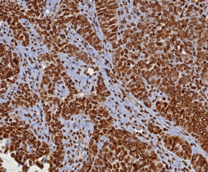 Formalin-fixed, paraffin-embedded human ovarian cancer (serous) stained with dsDNA antibody (DSD/8204R). HIER: Tris/EDTA, pH9.0, 45min. Secondary: HRP-polymer, 30min. DAB, 5min.