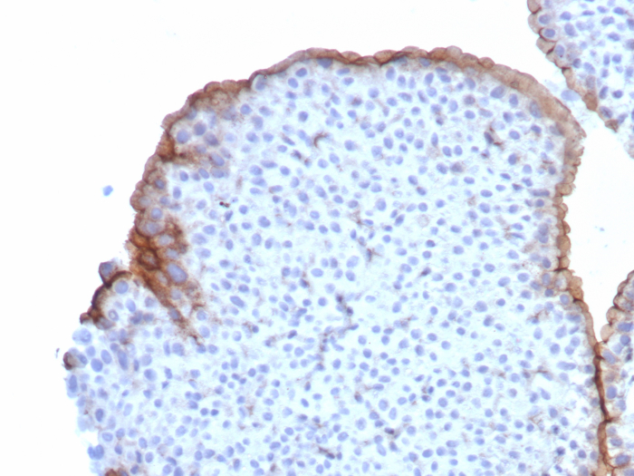 Formalin-fixed, paraffin-embedded human bladder stained with Uroplakin IIIB antibody (UPK3B/8550R). HIER: Tris/EDTA, pH9.0, 45min. Secondary: HRP-polymer, 30min. DAB, 5min.