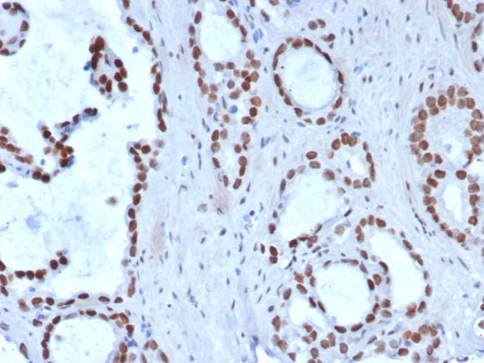 Formalin-fixed, paraffin-embedded human prostate carcinoma stained with TLE1 antibody (TLE1/8007R). HIER: Tris/EDTA, pH9.0, 45min. Secondary: HRP-polymer, 30min. DAB, 5min.