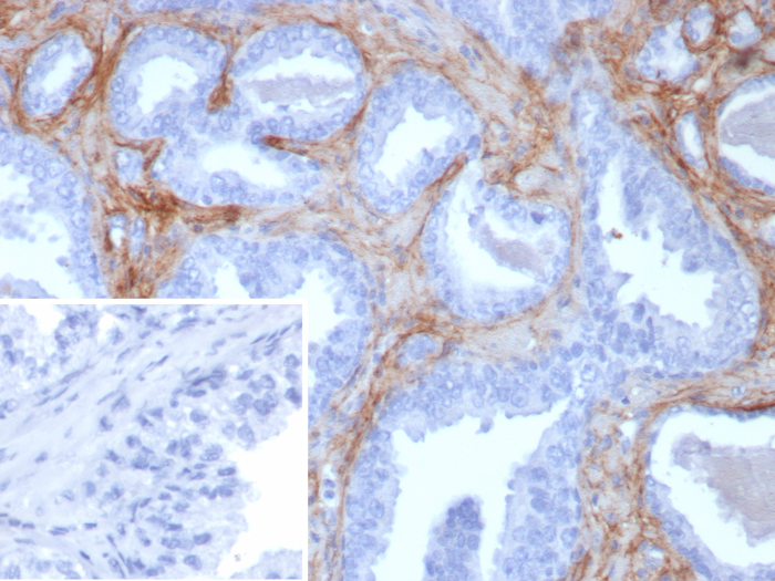 Formalin-fixed, paraffin-embedded human prostate stained with Periostin/OSF-2 antibody (rPOSTN/8522). Inset: PBS instead of primary antibody; secondary only negative control.