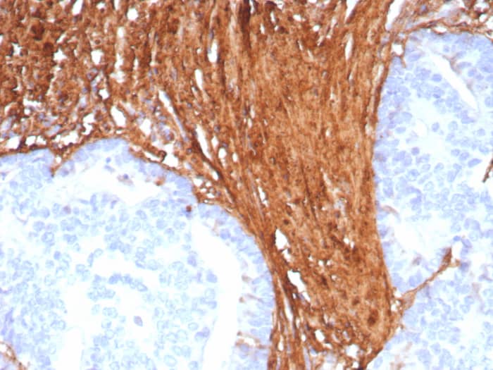 Formalin-fixed, paraffin-embedded human colon stained with Periostin Recombinant Rabbit Monoclonal Antibody (POSTN/8523R). HIER: Tris/EDTA, pH9.0, 45min. 2: HRP-polymer, 30min. DAB, 5min.