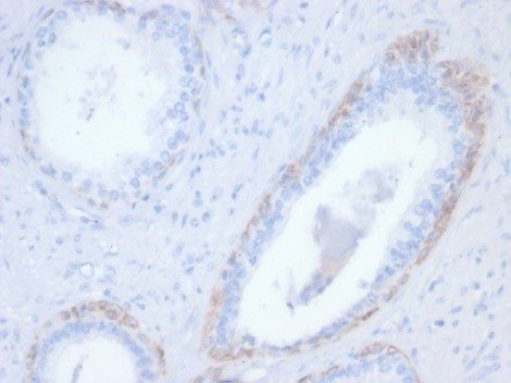 Formalin-fixed, paraffin-embedded human prostate stained with Cytokeratin 14 antibody (rKRT14/7368). HIER: Tris/EDTA, pH9.0, 45min. Secondary: HRP-polymer, 30min. DAB, 5min.