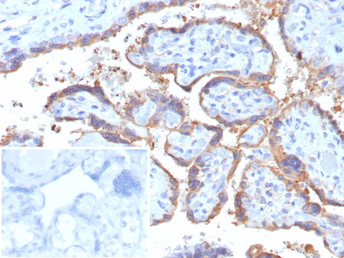 Formalin-fixed, paraffin-embedded human placenta stained with Chorionic Gonadotropin beta Chain (hCG beta) antibody (rHCGa/6975). Inset: PBS instead of primary antibody; secondary only negative control.