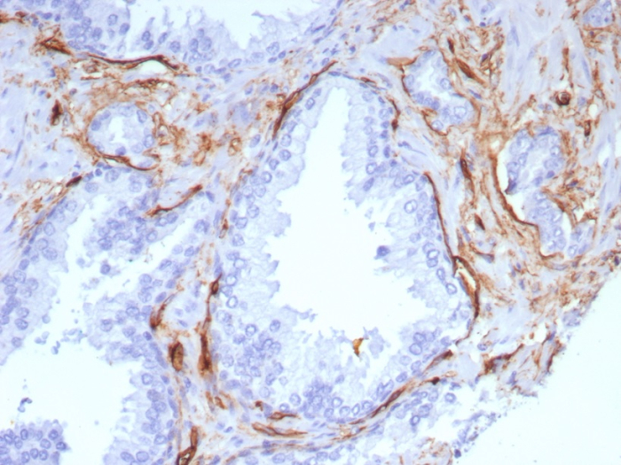 Formalin-fixed, paraffin-embedded human colon cancer stained with CD34 antibody (rHPCA1/8573). HIER: Tris/EDTA, pH9.0, 45min. Secondary: HRP-polymer, 30min. DAB, 5min.