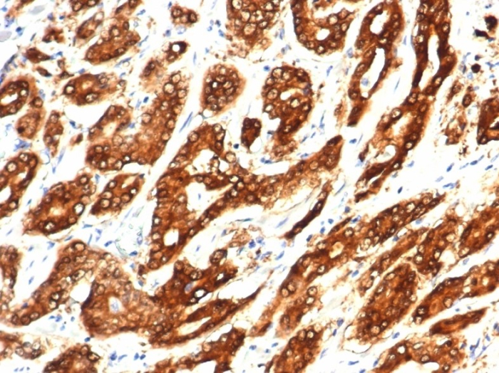 FFPE human prostate with IDH1-R132H mutation stained with Isocitrate Dehydrogenase 1/IDH1 antibody (IDH1.R132H/7277R).R132H/7277R). HIER: Tris/EDTA, pH9.0, 45min. Secondary: HRP-polymer, 30min. DAB, 5min.
