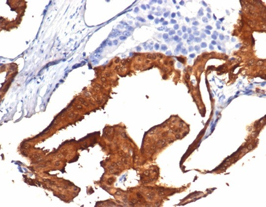 FFPE human prostate with IDH1-R132H mutation stained with Isocitrate Dehydrogenase 1/IDH1 antibody (IDH1.R132H/7277R).R132H/7277R). HIER: Tris/EDTA, pH9.0, 45min. Secondary: HRP-polymer, 30min. DAB, 5min.