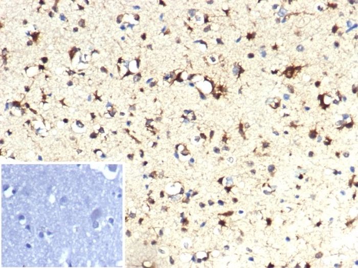 FFPE human brain with IDH1-R132H mutation stained with Isocitrate Dehydrogenase 1/IDH1 antibody (IDH1.R132H/7277R).R132H/7277R). Inset: PBS instead of primary antibody; secondary only negative control.