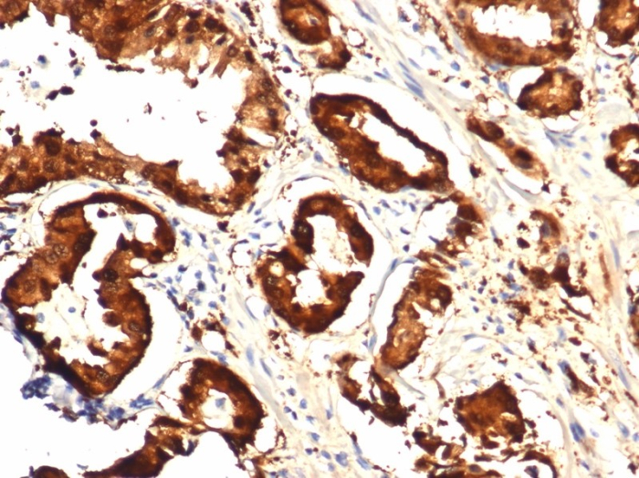 FFPE human prostate with IDH1-R132H mutation stained with Isocitrate Dehydrogenase 1/IDH1 antibody (IDH1.R132H/7328R).R132H/7328R). HIER: Tris/EDTA, pH9.0, 45min. Secondary: HRP-polymer, 30min. DAB, 5min.