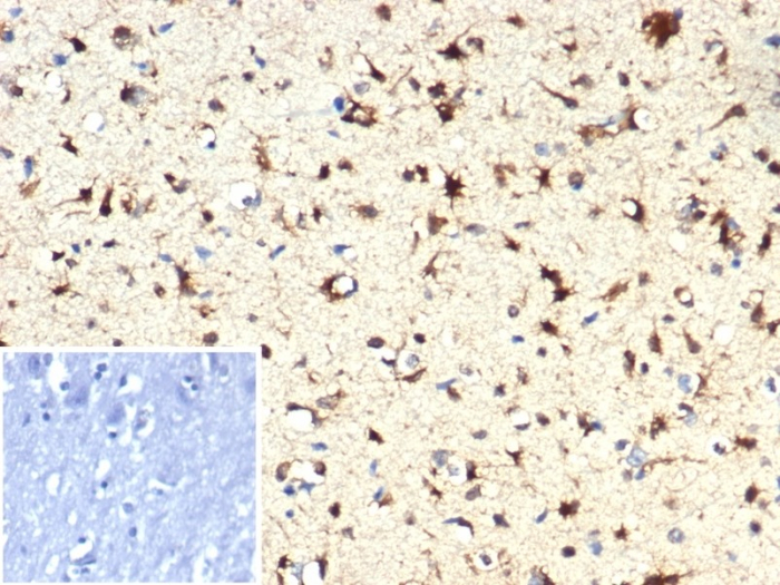FFPE human brain with IDH1-R132H mutation stained with Isocitrate Dehydrogenase 1/IDH1 antibody (IDH1.R132H/7328R).R132H/7328R). Inset: PBS instead of primary antibody; secondary only negative control.