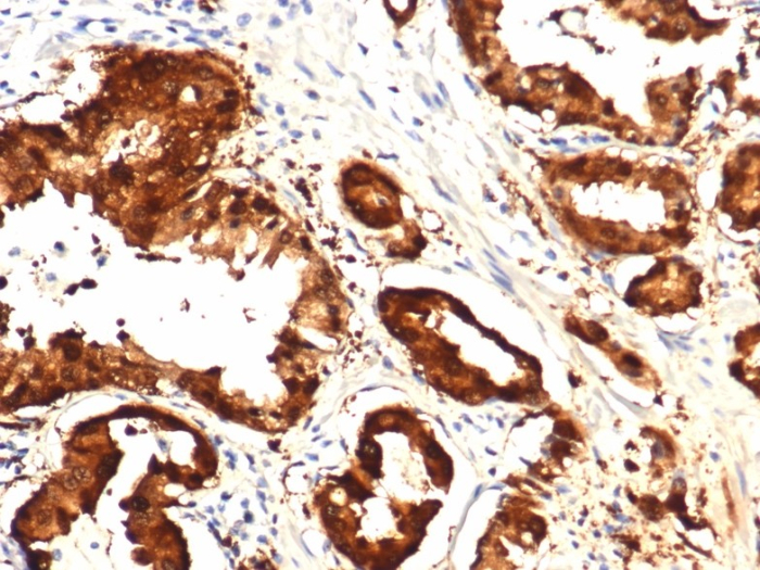 FFPE human prostate with IDH1-R132H mutation stained with Isocitrate Dehydrogenase 1/IDH1 antibody (IDH1.R132H/8205R).R132H/8205R). HIER: Tris/EDTA, pH9.0, 45min. Secondary: HRP-polymer, 30min. DAB, 5min.