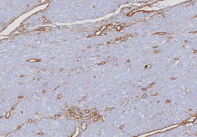 Formalin-fixed, paraffin-embedded human uterus stained with CD34 antibody (HPCA1/8333R). HIER: Tris/EDTA, pH9.0, 45min. Secondary: HRP-polymer, 30min. DAB, 5min.