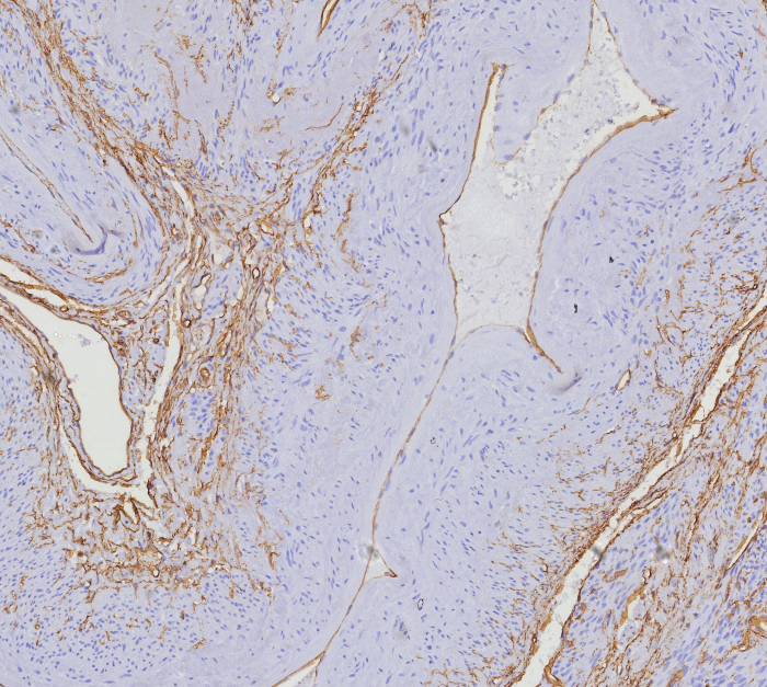 Formalin-fixed, paraffin-embedded human uterus stained with CD34 antibody (HPCA1/8353R). HIER: Tris/EDTA, pH9.0, 45min. Secondary: HRP-polymer, 30min. DAB, 5min.