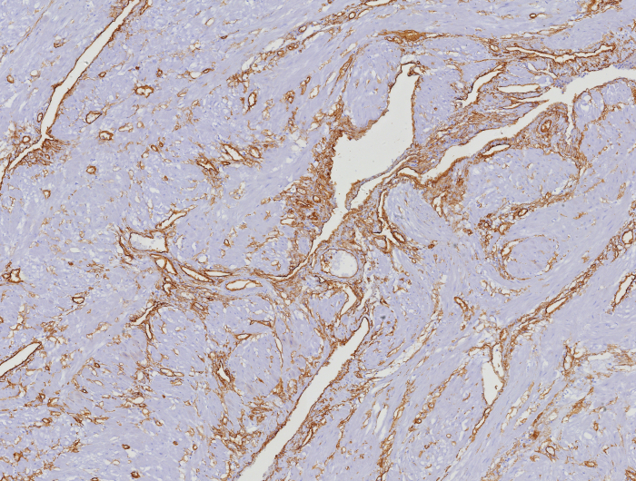 Formalin-fixed, paraffin-embedded human uterus stained with CD34 antibody (HPCA1/8353R). HIER: Tris/EDTA, pH9.0, 45min. Secondary: HRP-polymer, 30min. DAB, 5min.
