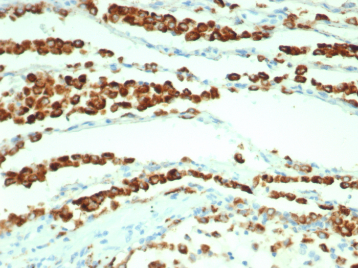 IHC analysis of formalin-fixed, paraffin-embedded human lung adenocarcinoma.Napsin A antibody (rNAPSA/7239) at 2ug/ml in PBS for 30min RT. HIER: Tris/EDTA, pH9.0, 45min. Secondary: HRP-polymer, 30min. DAB, 5min.