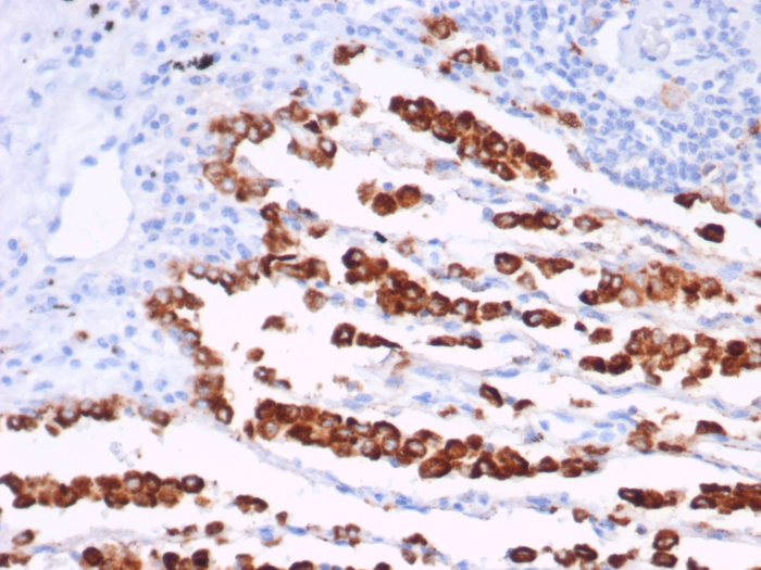 IHC analysis of formalin-fixed, paraffin-embedded human lung adenocarcinoma.Napsin A antibody (rNAPSA/7239) at 2ug/ml in PBS for 30min RT. HIER: Tris/EDTA, pH9.0, 45min. Secondary: HRP-polymer, 30min. DAB, 5min