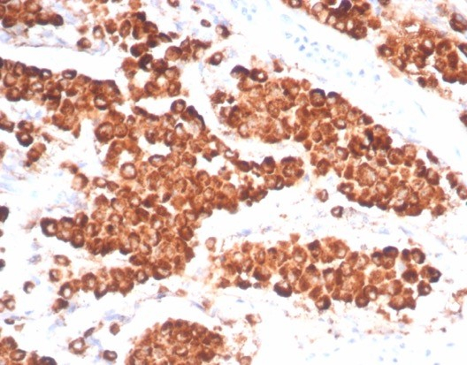 IHC analysis of formalin-fixed, paraffin-embedded human lung adenocarcinoma. Napsin A antibody (NAPSA/7165R) at 2ug/ml in PBS for 30min RT. HIER: Tris/EDTA, pH9.0, 45min. Secondary: HRP-polymer, 30min. DAB, 5min.