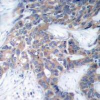Immunohistochemistry: MEK1/2 [p Ser221, p Ser217] Antibody - BSA Free [NBP3-20686] - Immunohistochemical analysis of paraffin-embedded human breast carcinoma tissue using MEK1/2 (p Ser221, p Ser217).