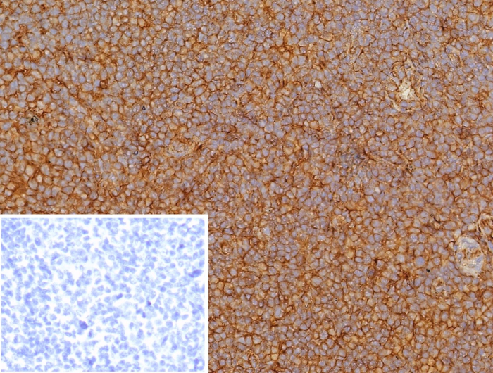 Formalin-fixed, paraffin-embedded human tonsil stained with HLA G antibody (HLAG/8344R). Inset: PBS instead of primary antibody; secondary only negative control.