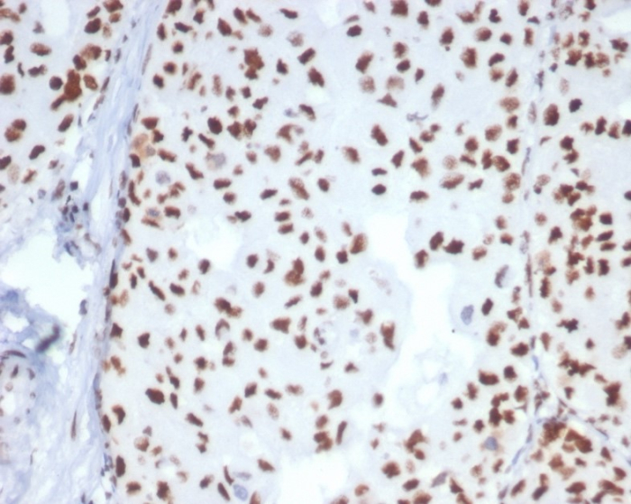 Formalin-fixed, paraffin-embedded human breast carcinoma stained with HspA1B antibody (HSPA1B/7624). HIER: Tris/EDTA, pH9.0, 45min. Secondary: HRP-polymer, 30min. DAB, 5min.