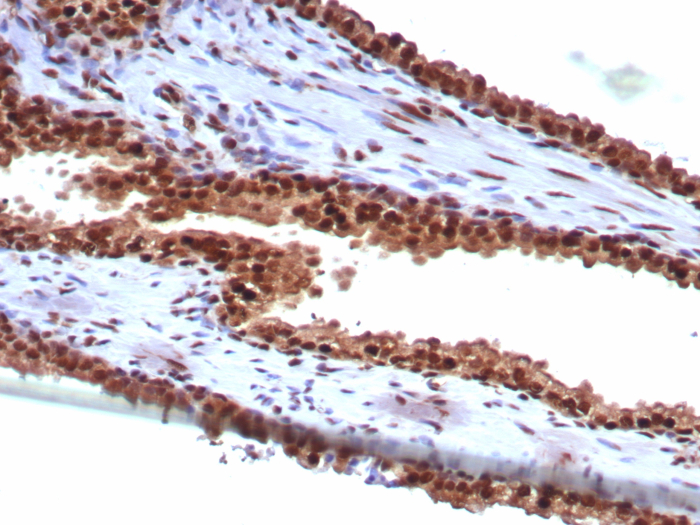 Formalin-fixed, paraffin-embedded human prostate stained with HspA1B antibody (HSPA1B/7629). HIER: Tris/EDTA, pH9.0, 45min. 2: HRP-polymer, 30min. DAB, 5min.