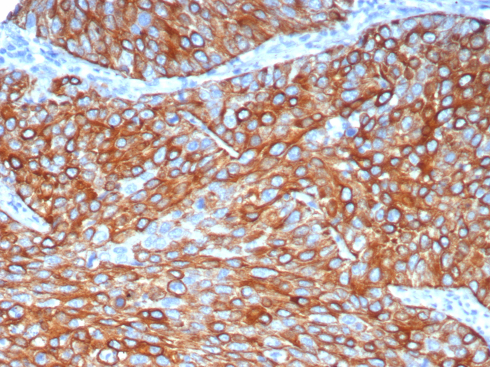 Formalin-fixed, paraffin-embedded human lung adenocarcinoma stained with Cytokeratin 6a antibody (KRT6/8120R). HIER: Tris/EDTA, pH9.0, 45min. Secondary: HRP-polymer, 30min. DAB, 5min.