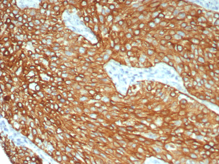 Formalin-fixed, paraffin-embedded human lung stained with Cytokeratin 6 antibody (KRT6/8198R). HIER: Tris/EDTA, pH9.0, 45min. Secondary: HRP-polymer, 30min. DAB, 5min.