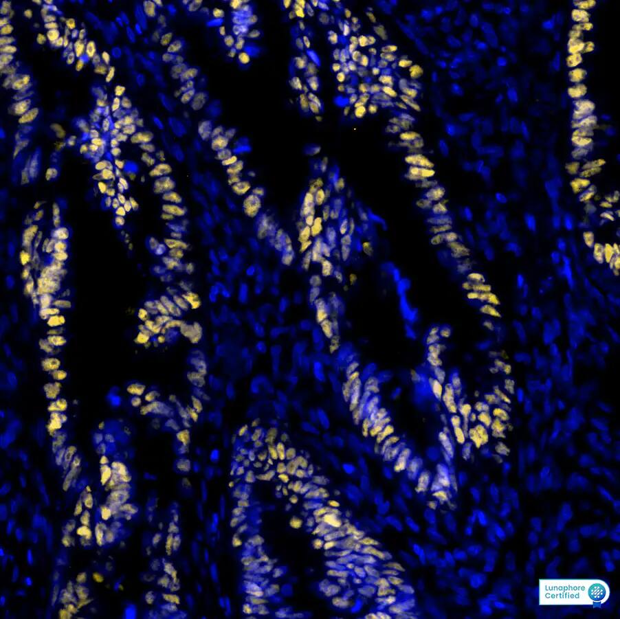 p53 was detected in immersion fixed paraffin-embedded sections of human Colon Tumor using Mouse Anti-Human p53 Monoclonal Antibody at 12ug/mL at 37°Celsius for 8 minutes. Before incubation with the primary antibody, tissue underwent an all-in-one dewaxing and antigen retrieval preprocessing using PreTreatment Module (PT Module) and Dewax and HIER Buffer H (pH 9; Epredia Catalog # TA-999-DHBH). Tissue was stained using the Alexa Fluor™ 555 Goat anti-Mouse IgG Secondary Antibody at 1:100 at 37°Celsius for 2 minutes. (Yellow; Lunaphore Catalog # DR555MS) and counterstained with DAPI (blue; Lunaphore Catalog # DR100). Specific staining was localized to the astrocytes showing nuclear staining. Protocol available in COMET™ Panel Builder.