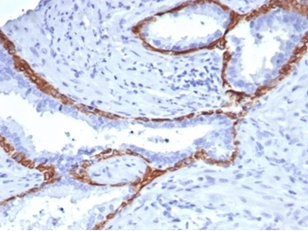 Formalin-fixed, paraffin-embedded human prostate stained with Cytokeratin 14 antibody (KRT14/4131). HIER: Tris/EDTA, pH9.0, 45min. Secondary: HRP-polymer, 30min. DAB, 5min.