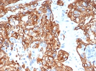 Formalin-fixed, paraffin-embedded human lung carcinoma stained with Cytokeratin 14 antibody (KRT14/6957). HIER: Tris/EDTA, pH9.0, 45min. Secondary: HRP-polymer, 30min. DAB, 5min.