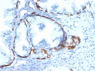 IHC analysis of formalin-fixed, paraffin-embedded human prostate. Cytokeratin 14 antibody (KRT14/6957). HIER: Tris/EDTA, pH9.0, 45min. Secondary: HRP-polymer, 30min. DAB, 5min.