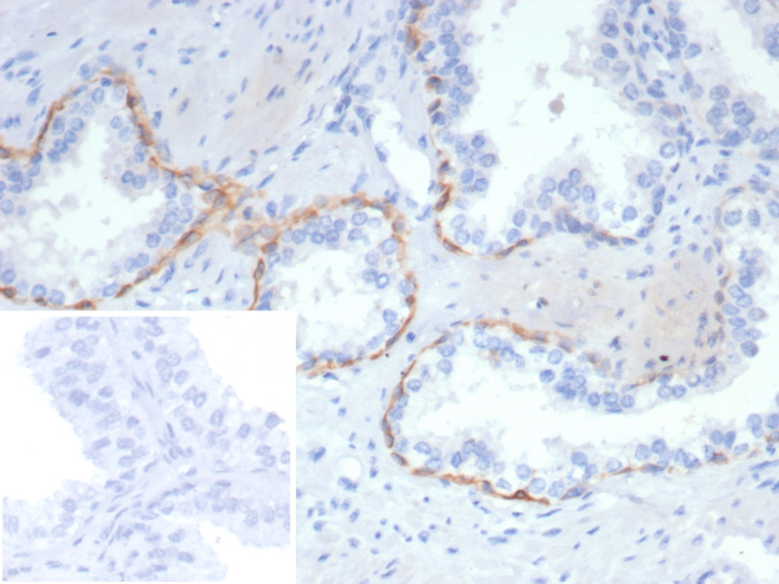 Formalin-fixed, paraffin-embedded human prostate stained with Cytokeratin 14 antibody (rKRT14/7269). Inset: PBS instead of primary antibody; secondary only negative control.