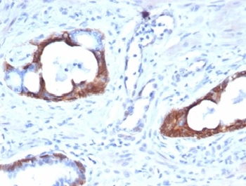 Formalin-fixed, paraffin-embedded human prostate carcinoma stained with Cytokeratin 14 antibody (KRT14/4127). HIER: Tris/EDTA, pH9.0, 45min. Secondary: HRP-polymer, 30min. DAB, 5min.