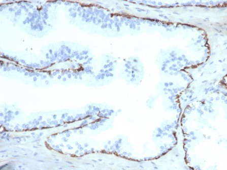 Formalin-fixed, paraffin-embedded human prostate stained with Cytokeratin 14 antibody (KRT14/6987R). HIER: Tris/EDTA, pH9.0, 45min. Secondary: HRP-polymer, 30min. DAB, 5min.