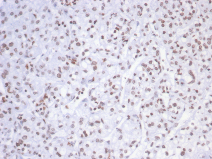 Formalin-fixed, paraffin-embedded human kidney carcinoma stained with SmarcAL1 antibody (PCRP-SMARCAL1-1C4). HIER: Tris/EDTA, pH9.0, 45min. Secondary: HRP-polymer, 30min. DAB, 5min.