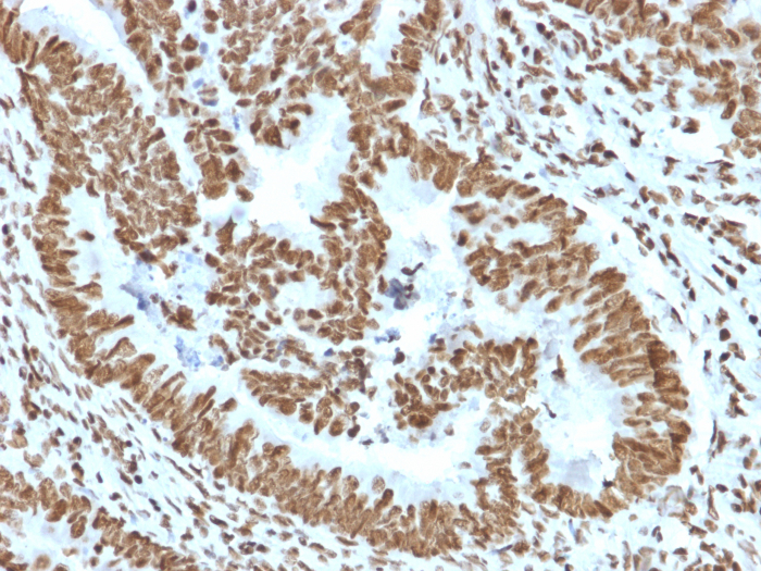 Formalin-fixed, paraffin-embedded human colon carcinoma stained with ZNF846 antibody (PCRP-ZNF846-1E12). HIER: Tris/EDTA, pH9.0, 45min. Secondary: HRP-polymer, 30min. DAB, 5min.