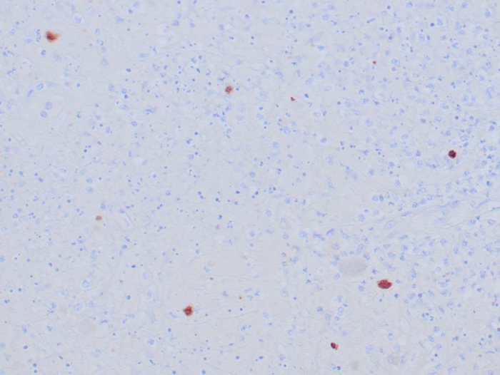 Formalin-fixed, paraffin-embedded human HSV-infected tissue stained with Herpes Simplex Virus 1 antibody (HSVI/8375R). HIER: Tris/EDTA, pH9.0, 45min. Secondary: HRP-polymer, 30min. DAB, 5min.