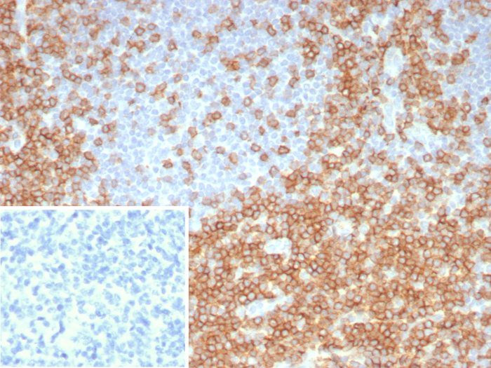 Formalin-fixed, paraffin-embedded human tonsil stained with CD5 antibody (C5/8117R). Inset: PBS instead of primary antibody; secondary only negative control.