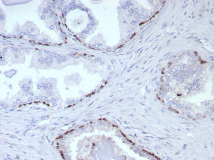 Formalin-fixed, paraffin-embedded human prostate cancer stained with p63 Recombinant Mouse Monoclonal Antibody (rP40/8765). HIER: Tris/EDTA, pH9.0, 45min. 2: HRP-polymer, 30min. DAB, 5min.