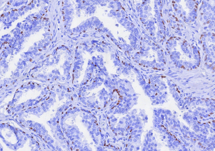 Formalin-fixed, paraffin-embedded human prostate cancer stained with p63/TP73L antibody (TP63/7807R). HIER: Tris/EDTA, pH9.0, 45min. Secondary: HRP-polymer, 30min. DAB, 5min.