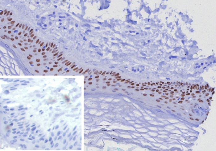 Formalin-fixed, paraffin-embedded human skin stained with p63/TP73L antibody (TP63/7807R). Inset: PBS instead of primary antibody; secondary only negative control.