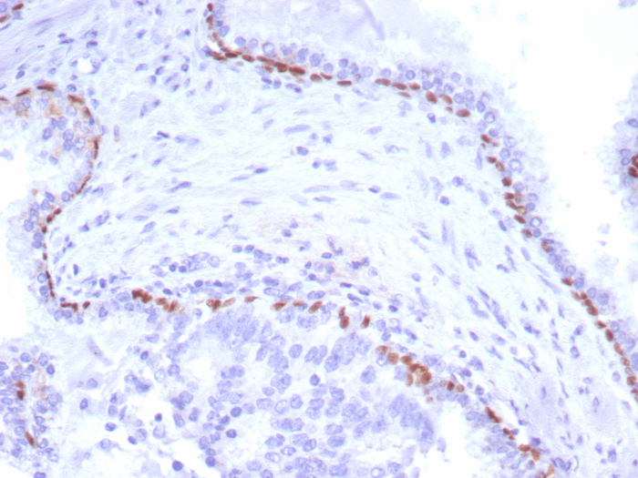 Formalin-fixed, paraffin-embedded human prostate carcinoma stained with p40/deltaNp63 antibody (P40/8225R). HIER: Tris/EDTA, pH9.0, 45min. 2: HRP-polymer, 30min. DAB, 5min.