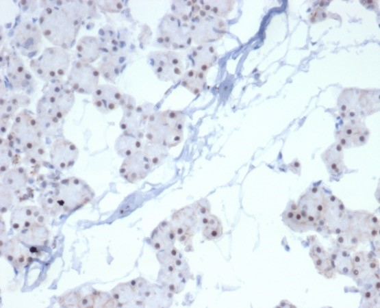 Formalin-fixed, paraffin-embedded human renal cell carcinoma stained with PHOX2B antibody (PHOX2B/7161R). HIER: Tris/EDTA, pH9.0, 45min. Secondary: HRP-polymer, 30min. DAB, 5min.