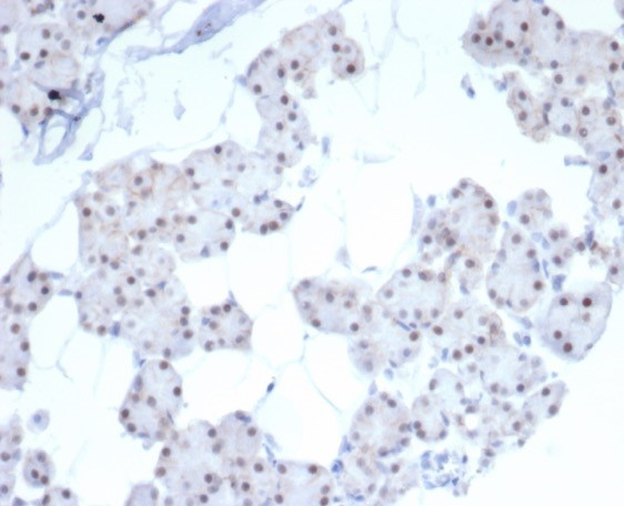 Formalin-fixed, paraffin-embedded human renal cell carcinoma stained with PHOX2B antibody (PHOX2B/7792R). HIER: Tris/EDTA, pH9.0, 45min. Secondary: HRP-polymer, 30min. DAB, 5min.