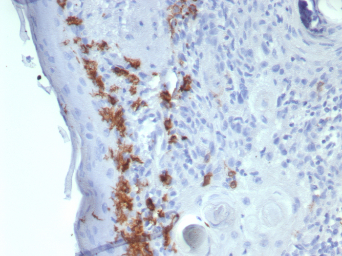 Formalin-fixed, paraffin-embedded human skin stained with CD1a antibody (C1A/8111R). HIER: Tris/EDTA, pH9.0, 45min. Secondary: HRP-polymer, 30min. DAB, 5min.