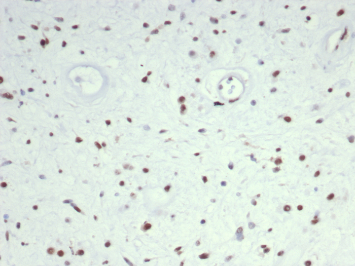 Formalin-fixed, paraffin-embedded human rhabdomyosarcoma stained with MyoD antibody (MYOD1/7149). HIER: Tris/EDTA, pH9.0, 45min. Secondary: HRP-polymer, 30min. DAB, 5min.