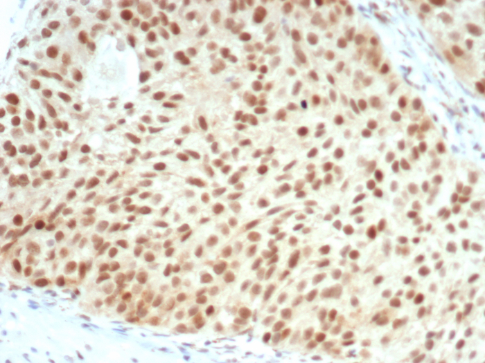 Formalin-fixed, paraffin-embedded human bladder carcinoma stained with RB1 antibody (RB1/7080R). HIER: Tris/EDTA, pH9.0, 45min. Secondary: HRP-polymer, 30min. DAB, 5min.