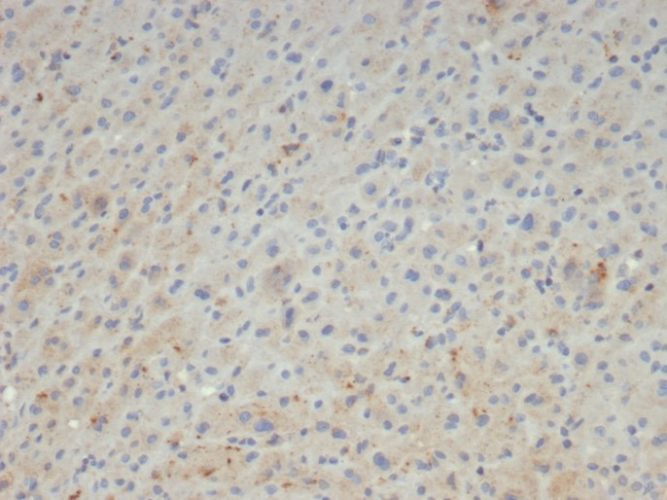 Formalin-fixed, paraffin-embedded human hepatocellular carcinoma stained with alpha 2-Macroglobulin antibody (A2M/4847). HIER: Tris/EDTA, pH9.0, 45min. Secondary: HRP-polymer, 30min. DAB, 5min.