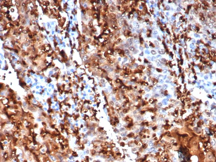 Formalin-fixed, paraffin-embedded human lung cancer stained with S100P Recombinant Mouse Monoclonal Antibody (S100P/7373). HIER: Tris/EDTA, pH9.0, 45min. 2: HRP-polymer, 30min. DAB, 5min.