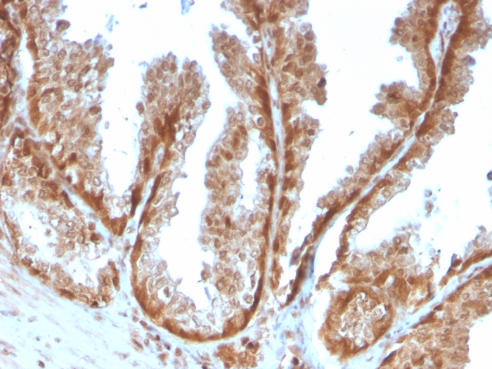 Formalin-fixed, paraffin-embedded human prostate stained with SOD1/Cu-Zn SOD antibody (SOD1/4593). HIER: Tris/EDTA, pH9.0, 45min. Secondary: HRP-polymer, 30min. DAB, 5min.