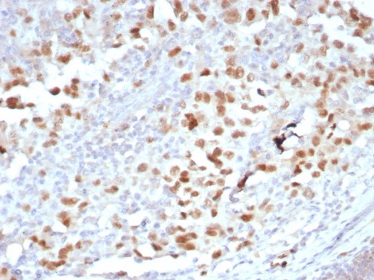 Formalin-fixed, paraffin-embedded human melanoma stained with PRAME antibody (PRAME/6928R). HIER: Tris/EDTA, pH9.0, 45min. Secondary: HRP-polymer, 30min. DAB, 5min.